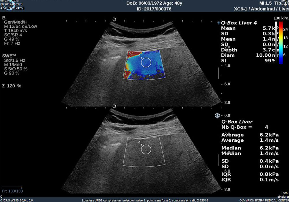 Ελαστογραφία ήπατος