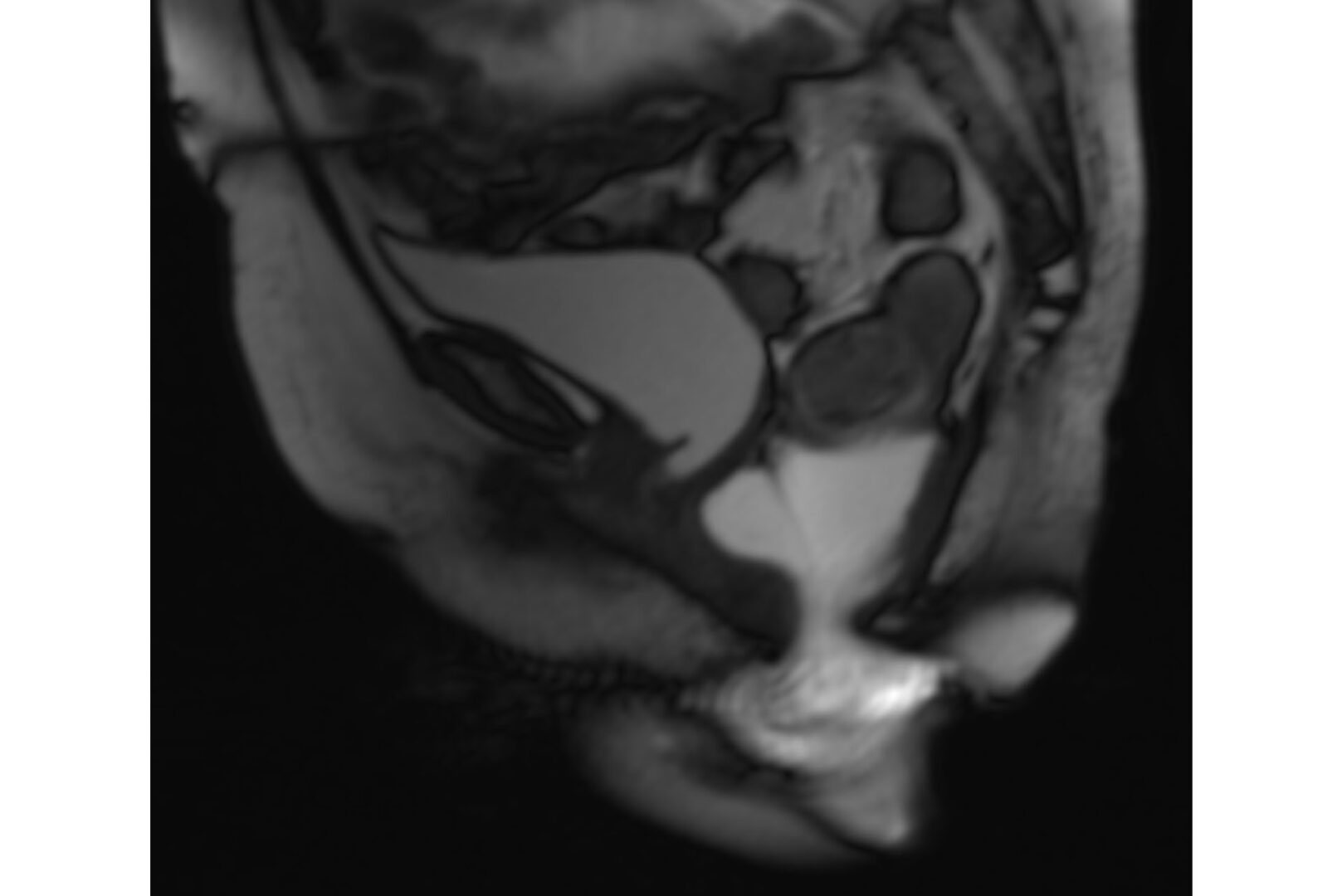 MRI defecography